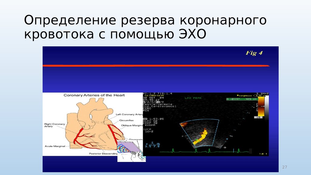 Скорость эхо. Определение фракционного резервного кровотока. Измерение коронарного резерва кровотока. Измерение фракционного резерва коронарного кровотока. Фракционный резерв кровотока.