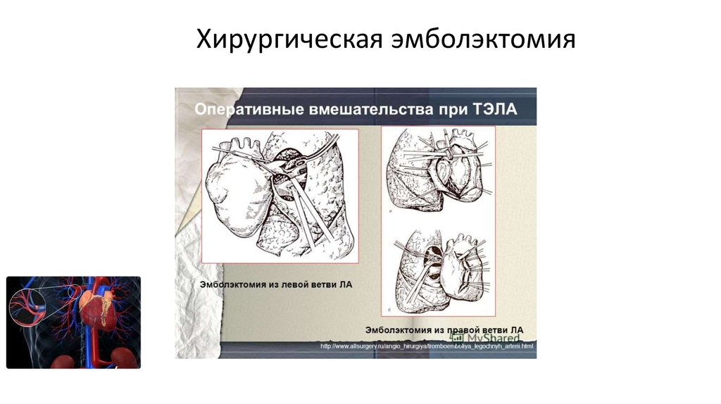 Дисфункция клапана легочной артерии