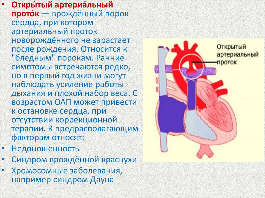 Оап у новорожденных. Врожденный порок сердца открытый артериальный проток. ВПС: - открытый Баталов проток. Открытый (персистирующий) артериальный проток. Боталлов проток у новорожденных.