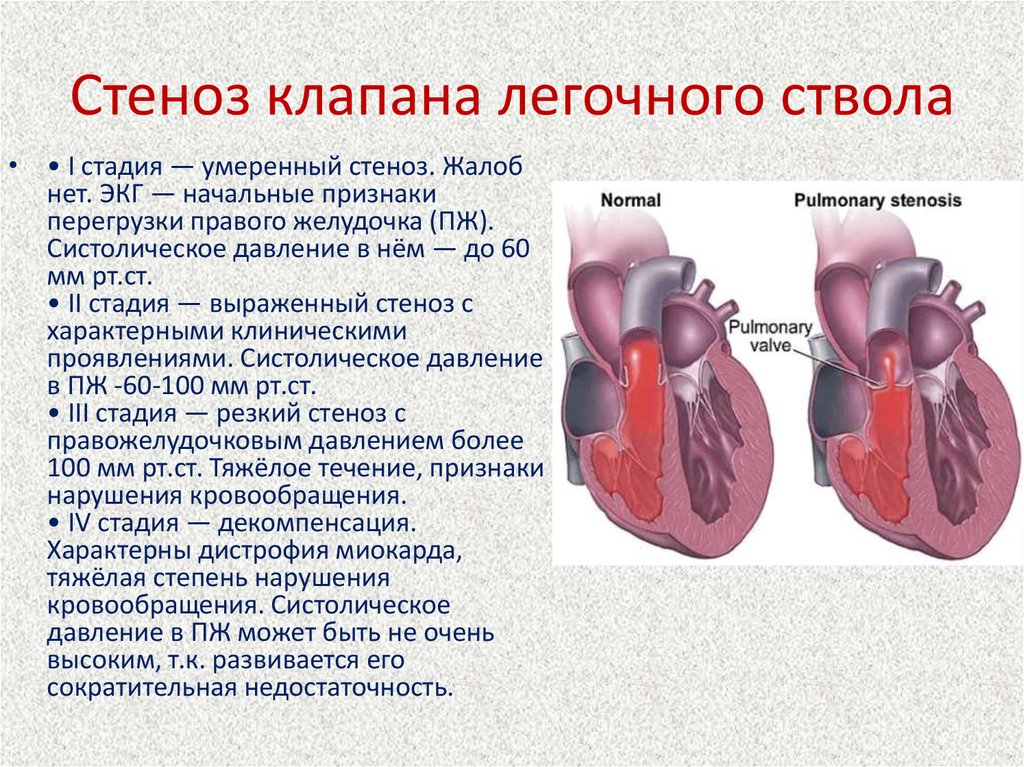Сердечный стеноз. Стеноз легочной артерии ЭХОКГ. Клинические симптомы стеноза легочной артерии. Изолированный клапанный стеноз легочной артерии. Пороки сердца стеноз клапана легочной артерии.