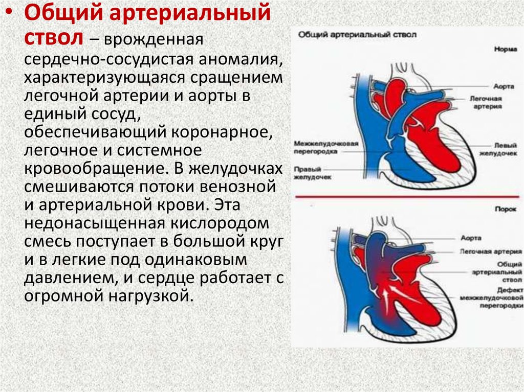 Градиент между желудочками. ВПС общий артериальный ствол у плода. Общий артериальный ствол нарушение гемодинамики. Пороки развития сердца общий артериальный ствол. Общий артериальный ствол 2 типа.