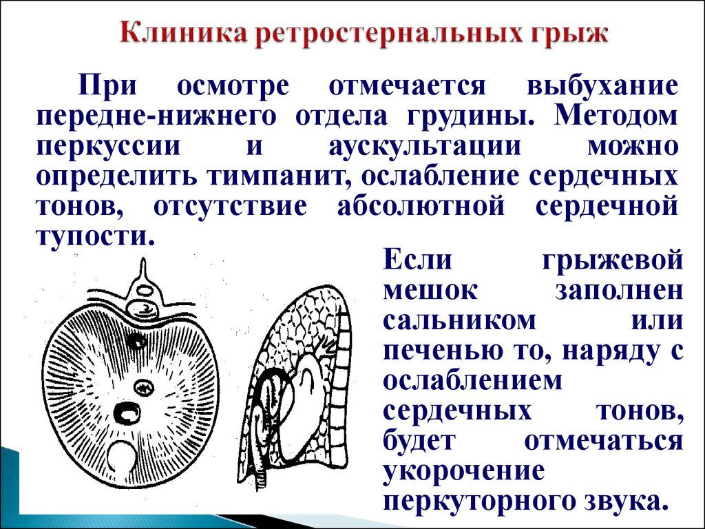 Диафрагмальные грыжи у детей презентация