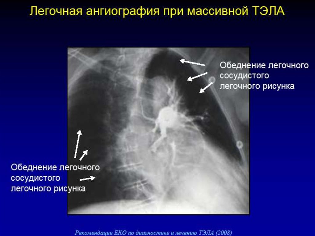 Острой тромбоэмболии легочной артерии. Тэла массивная Субмассивная. Субмассивная тромбоэмболия легочных артерий. Венозные тромбозы и тромбоэмболия лёгочной артерии. Массивная Тэла рентген.