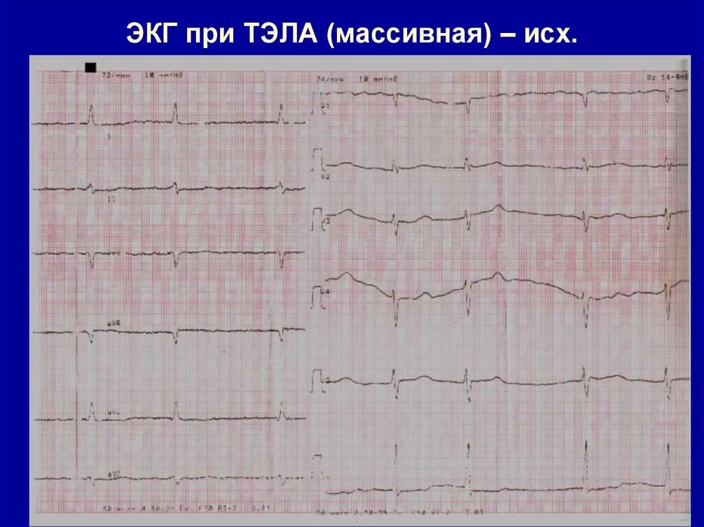 Эликвис при тэла схема