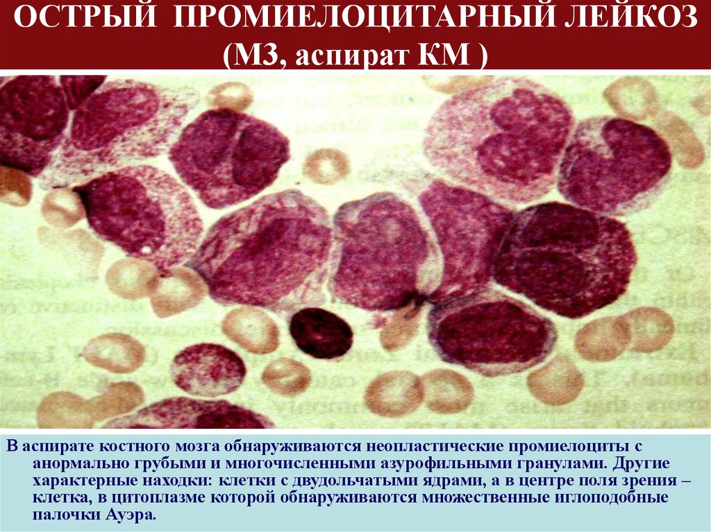 Картина лейкоза. Промиелоцитарный лейкоз патанатомия. Острый миелобластный лейкоз промиелоцитарный. Острый промиелоцитарный лейкоз м3.