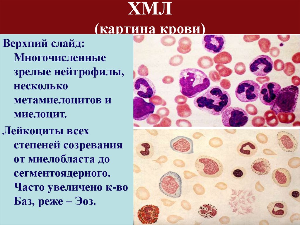 Миелолейкоз. Микроскопия хронический миелобластный лейкоз. Хронический миелоцитарный лейкоз (ХМЛ). Хронический миелолейкоз картина крови.