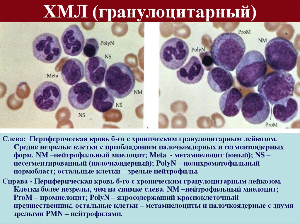 Нормобласты. Миелоциты промиелоциты метамиелоциты. Хронический миелоцитарный лейкоз показатели крови. Миелоцит и метамиелоцит. Миелоциты нейтрофилы метамиелоциты.