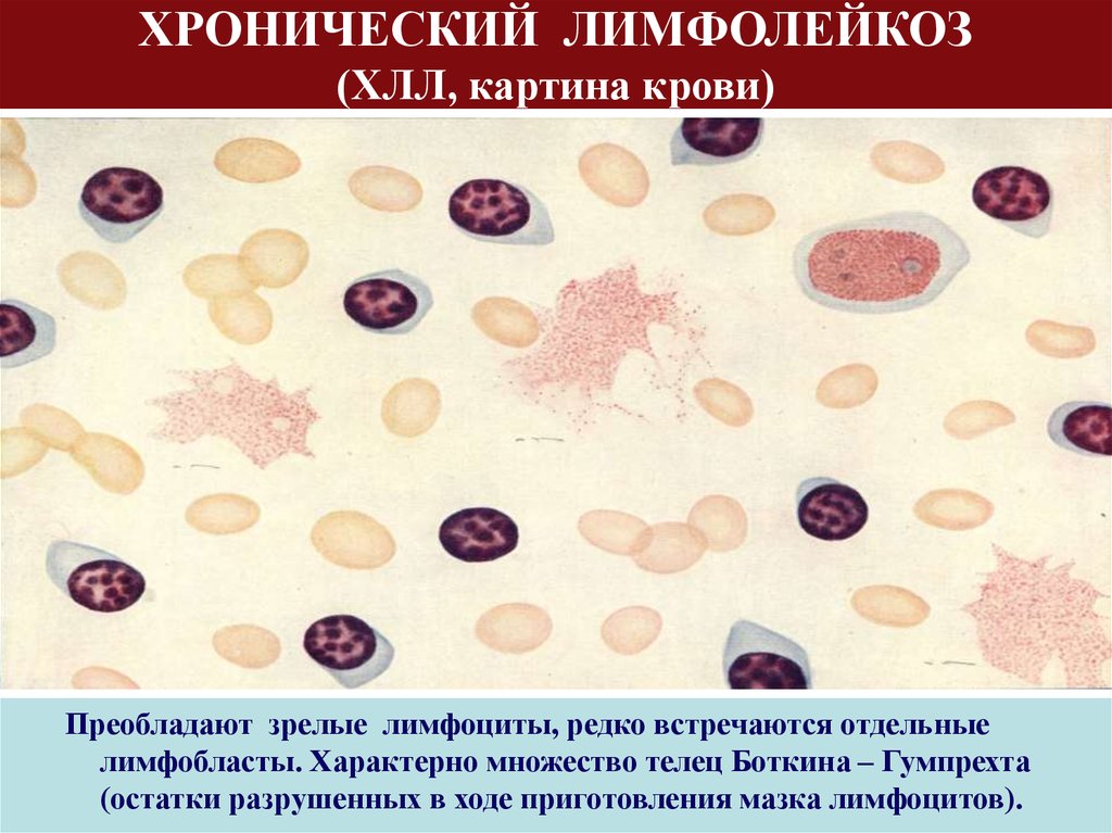 Лимфолейкоз. Тени Боткина Гумпрехта мазок крови. Тельца Боткина Гумпрехта. Клетки Клейна-Гумпрехта-Боткина. Тени Боткина-Гумпрехта норма.