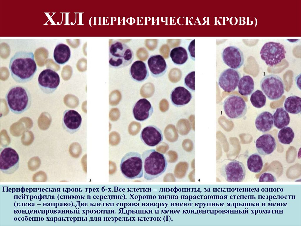 Картина крови хронического лимфолейкоза