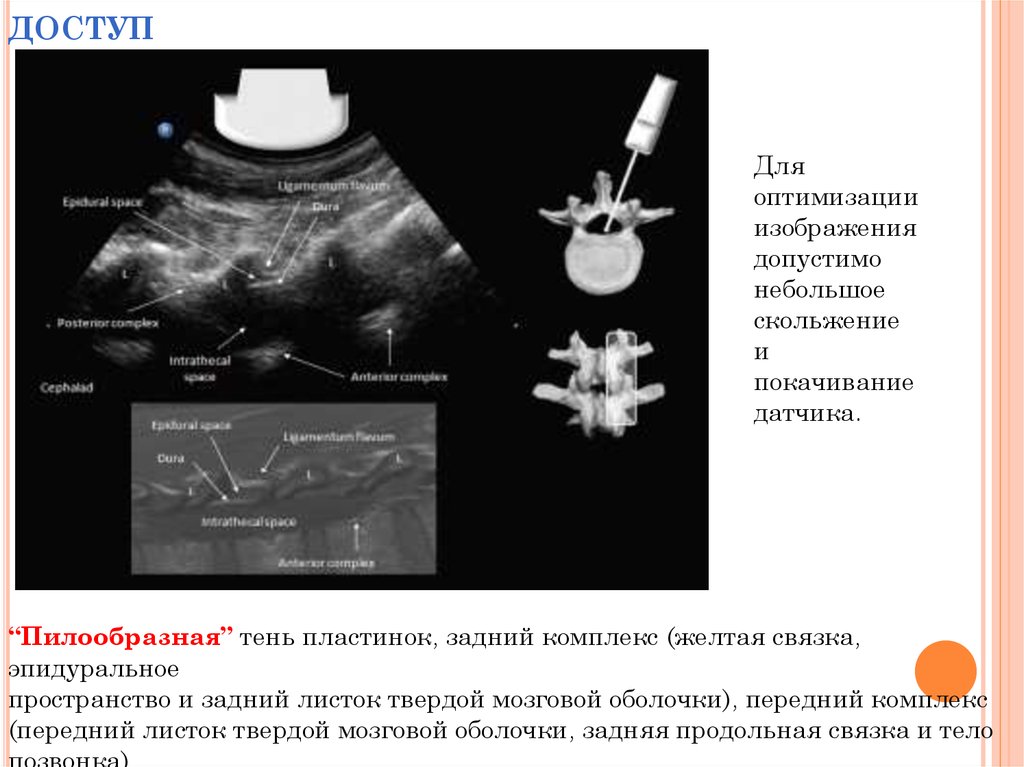 Операция узи. УЗИ спинальная анестезия. Спинномозговая анестезия под УЗИ. Спинальная анестезия парамедиальный доступ. Спинномозговая анестезия под УЗИ контролем.