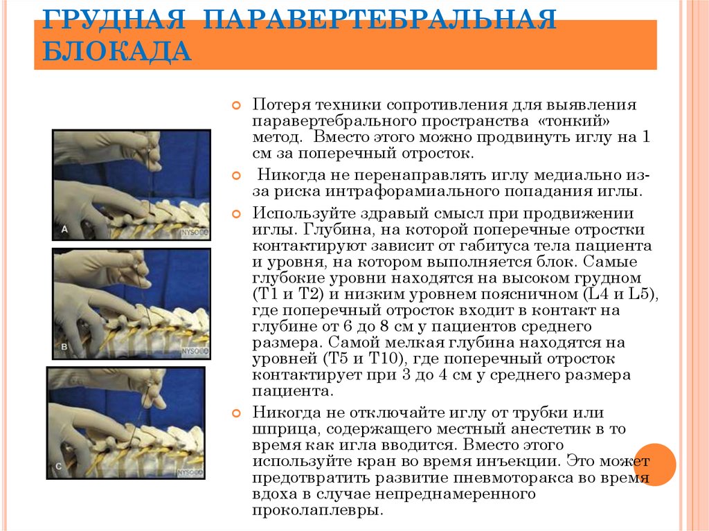 Паравертебральная блокада техника выполнения в картинках