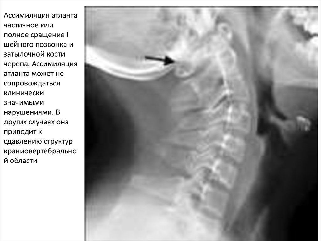 Аномалия шейного отдела позвоночника