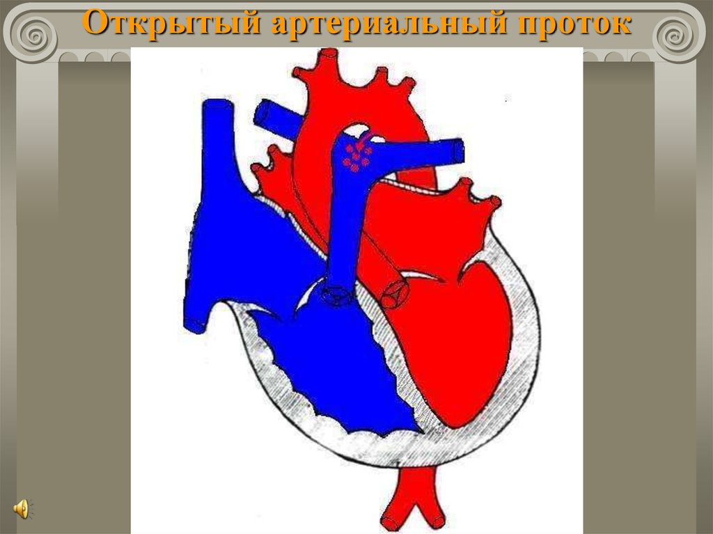 Оап у новорожденных. Открытый артериальный (боталлов) проток у собак. Открытый аортальный проток рисунок. Врожденный порок сердца открытый артериальный проток. Открытый артериальный проток Баталов.