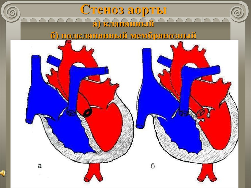 Стеноз аорты у детей презентация