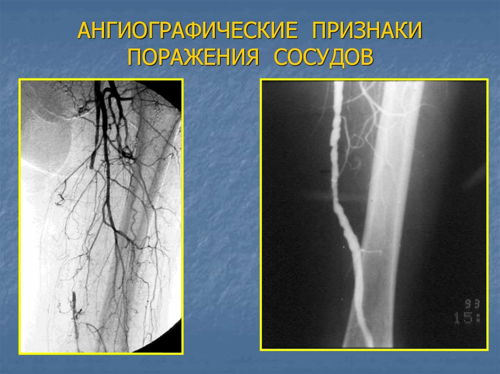 Нарушение артерия. Облитерирующий эндартериит ангиография. Ангиография артерий нижних конечностей. Ангиография атеросклероз. Ангиография периферических артерий.