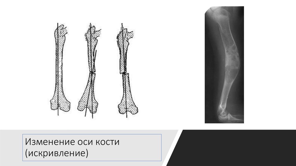 Изм оси. Постостеомиелитическая деформация костей. Ось кости. Оси костей. Осевая кость.
