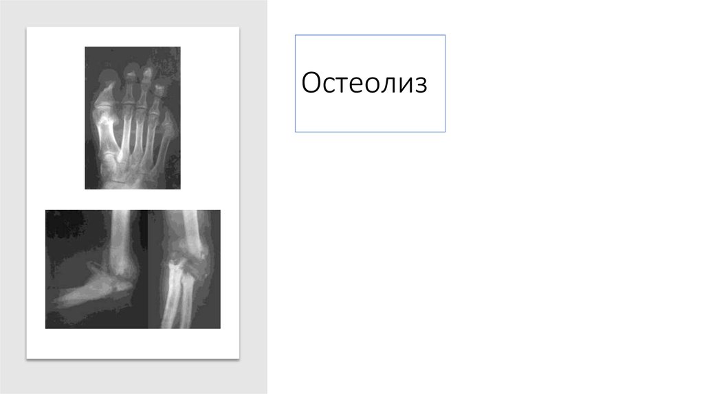 Остеолиз это. Остеолиз кости рентген. Остеолиз бедренной кости. Посттравматический остеолиз. Остеолиз рентген признаки.