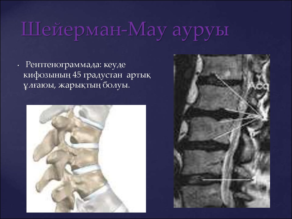 Болезнь шейермана мау. Болезнь Шейермана МАУ мрт. Болезнь Шойерман-МАУ кт. Шойерман МАУ болезнь на мрт позвоночника.