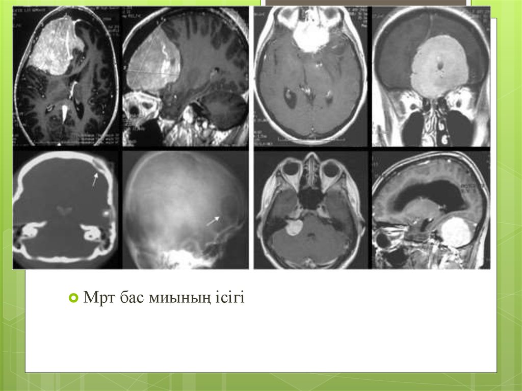 Диагнозы мрт. Доброкачественная опухоль головного мозга мрт. Менингиома решетчатой кости кт. Злокачественная опухоль мозга на кт. Доброкачественная злокачественная опухоль головного мозга мрт.