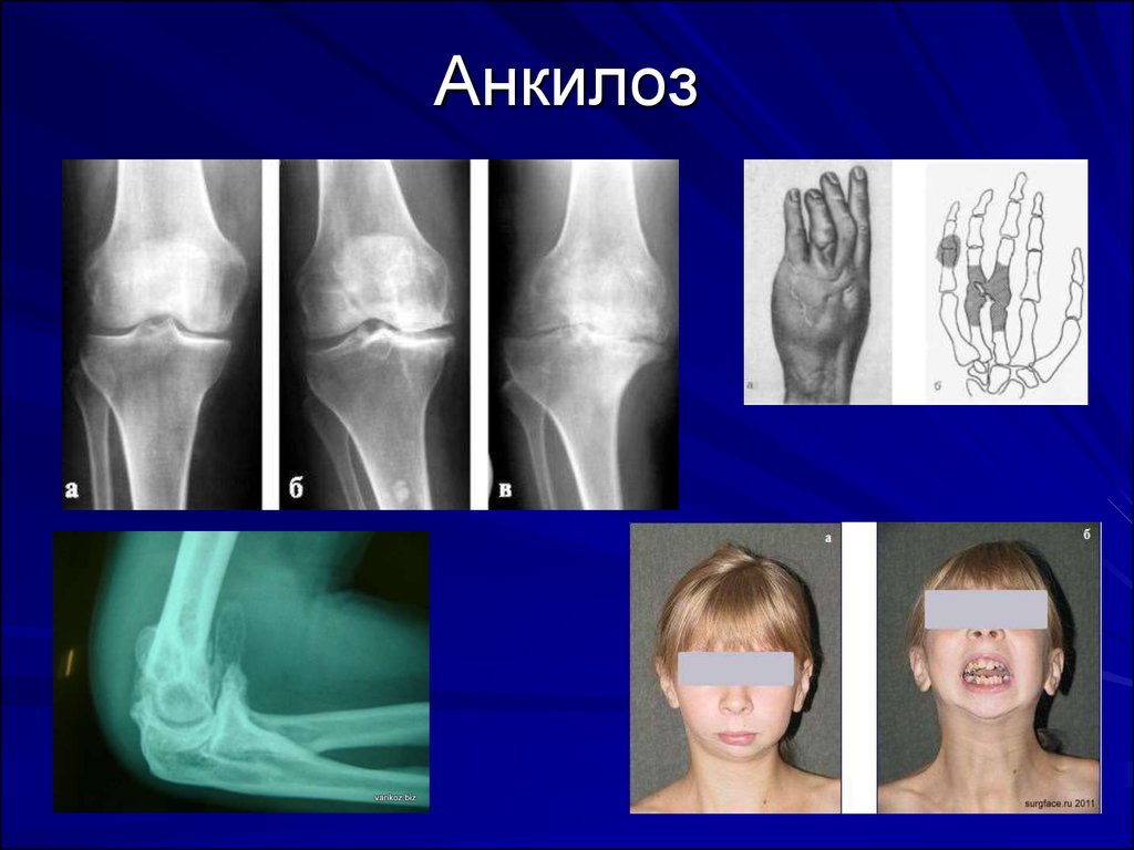 Анкилоз лечение. Костный анкилоз на рентгене. Анкилоз сустава рентген. Костный анкилоз коленного сустава. Анкилоз коленного сустава рентген.