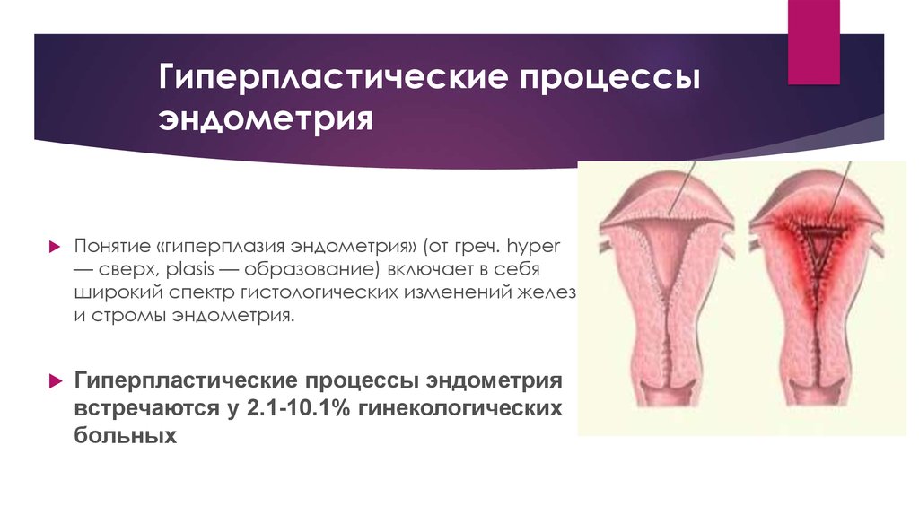 Гипопластического эндометрия