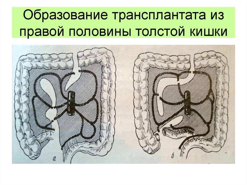 Образование трансплантата из правой половины толстой кишки
