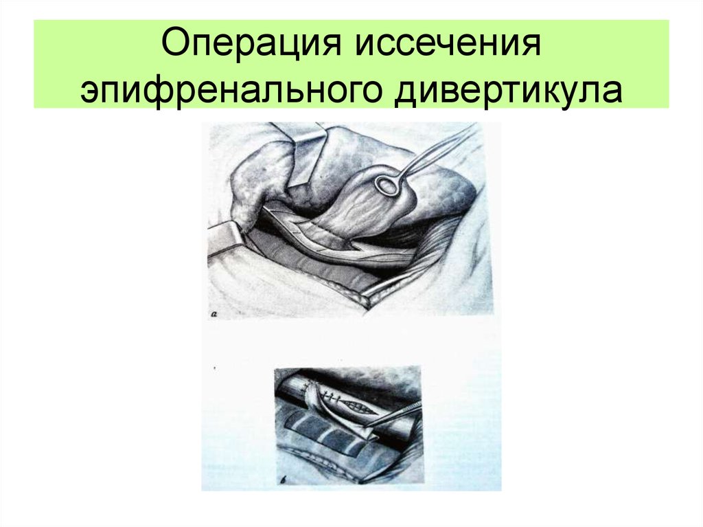 Операция иссечения эпифренального дивертикула