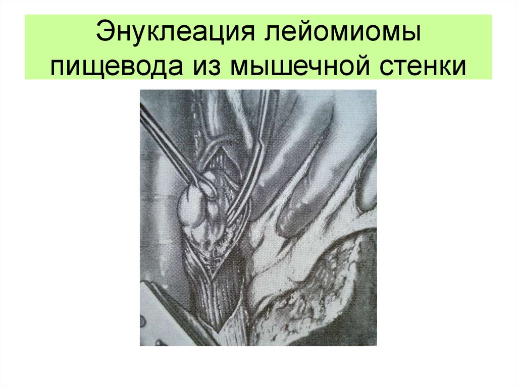 Энуклеация лейомиомы пищевода из мышечной стенки