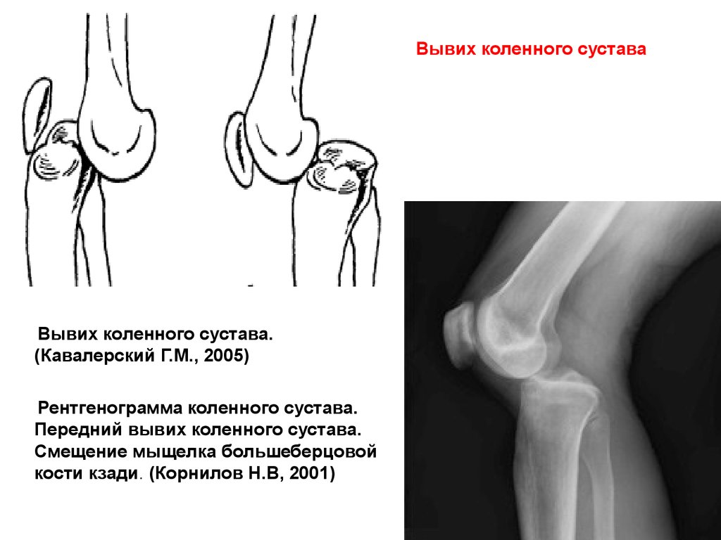 Смещение мыщелка. Вывих коленного сустава рентген. Вывих чашечки коленного сустава рентген. Рентген колена сустава вывих. Передний вывих большеберцовой кости.