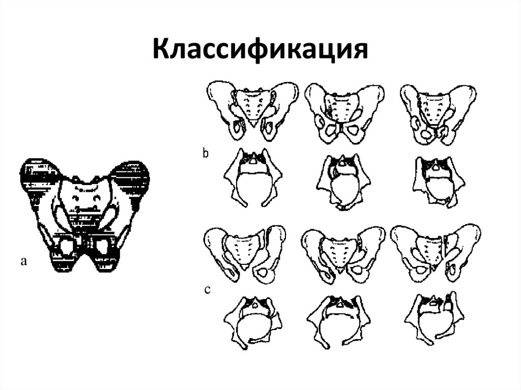 Переломы таза у детей презентация