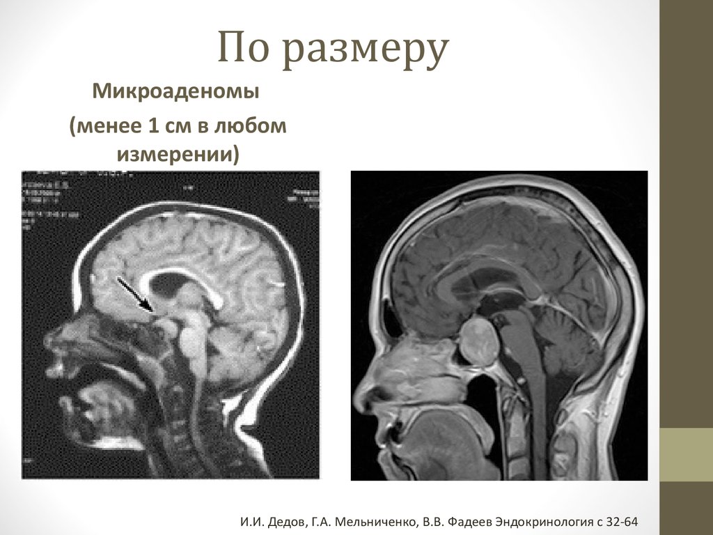 Размер гипофиза