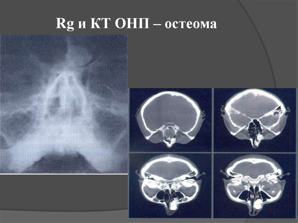 Кт околоносовой пазухи. Остеома решетчатой кости. Кт ОНП.