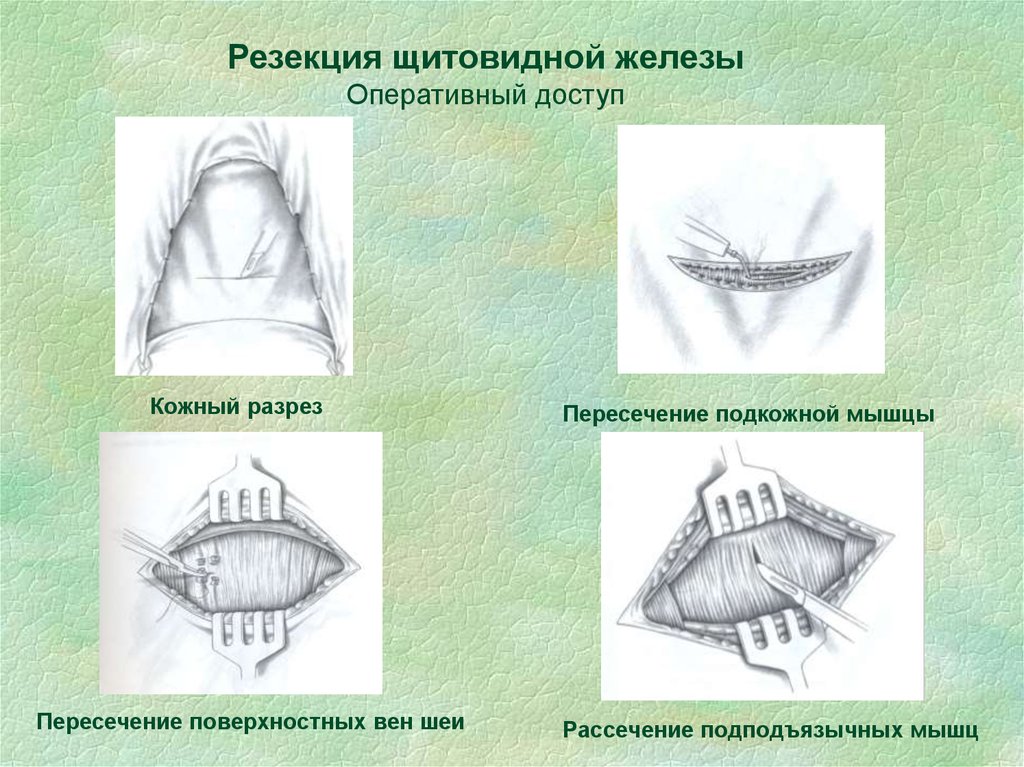 Резекция верхней челюсти презентация