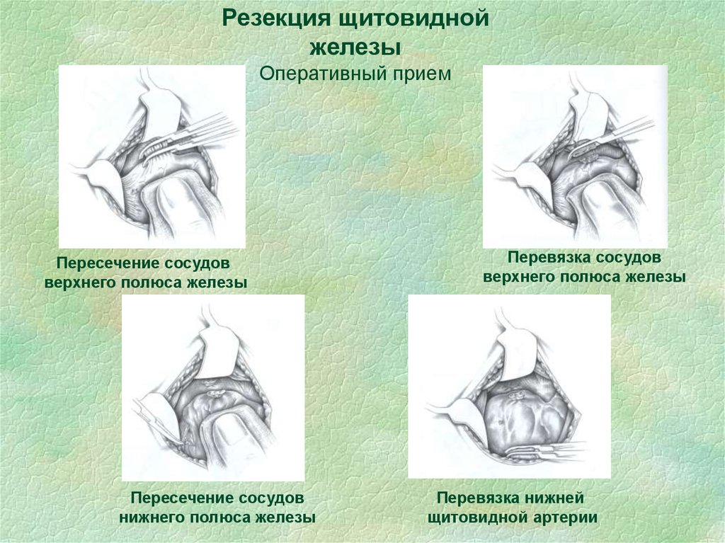 Резекция щитовидной железы. Полюса щитовидной железы. Верхний и Нижний полюс щитовидной железы. Резекция сосудов щитовидной железы.