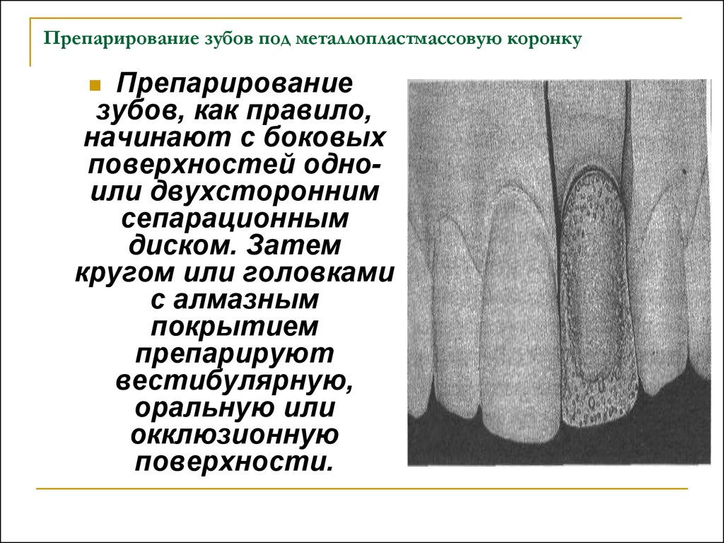 Препарирование под металлическую коронку схема