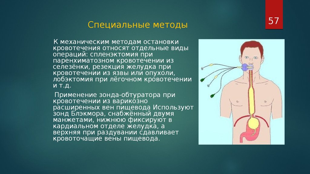 Кровь из пищевода. Остановка желудочного кровотечения баллоном. Способы остановки желудочного кровотечения. Способы остановки легочного кровотечения. Зонд при желудочном кровотечении.