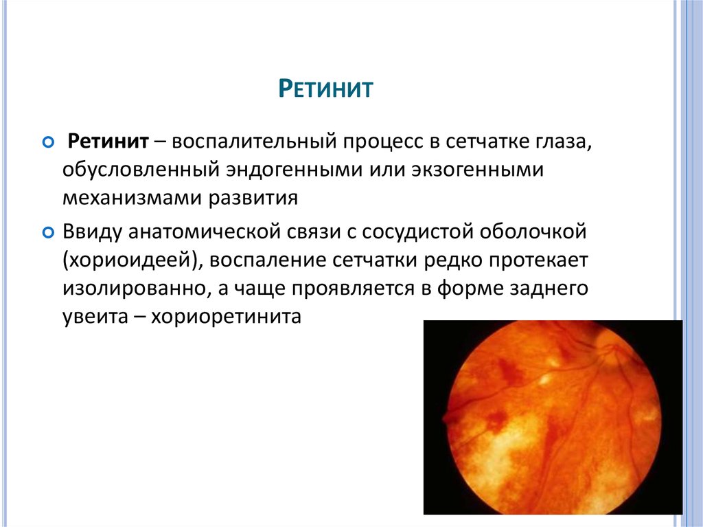 Воспаление сетчатки. Пигментная дегенерация сетчатки глаза. Пигментный ретинит этиология. Пигментный ретинит сетчатки. Воспаления сетчатки ретиниты.