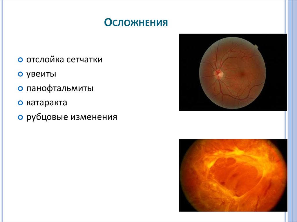 Отслойка сетчатки причины. Отслойка сетчатки катаракта. Клиническая картина отслойки сетчатки.