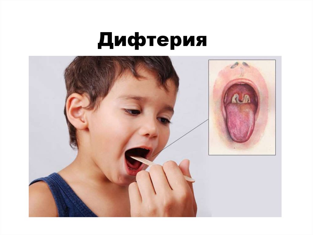 Клиническая картина дифтерии у детей