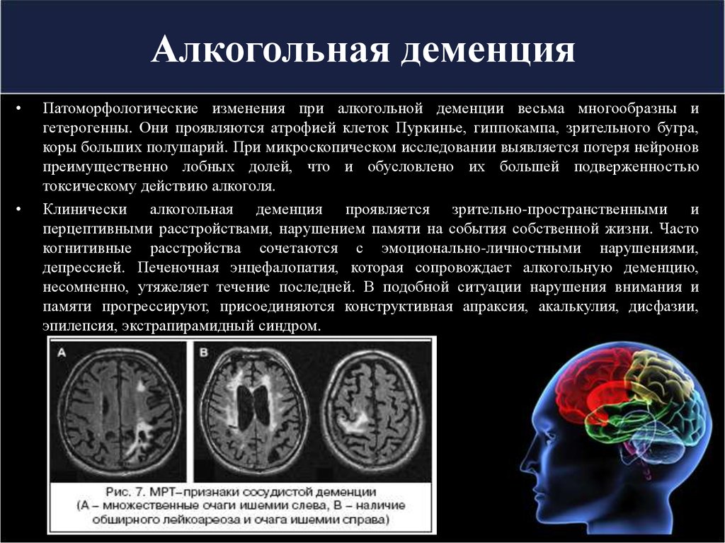 Энцефалопатия головного мозга последствия. Алкогольная деменция. Алкогольная деменция симптомы. Алкоголизм энцефалопатия. Деменция на фоне алкоголизма.