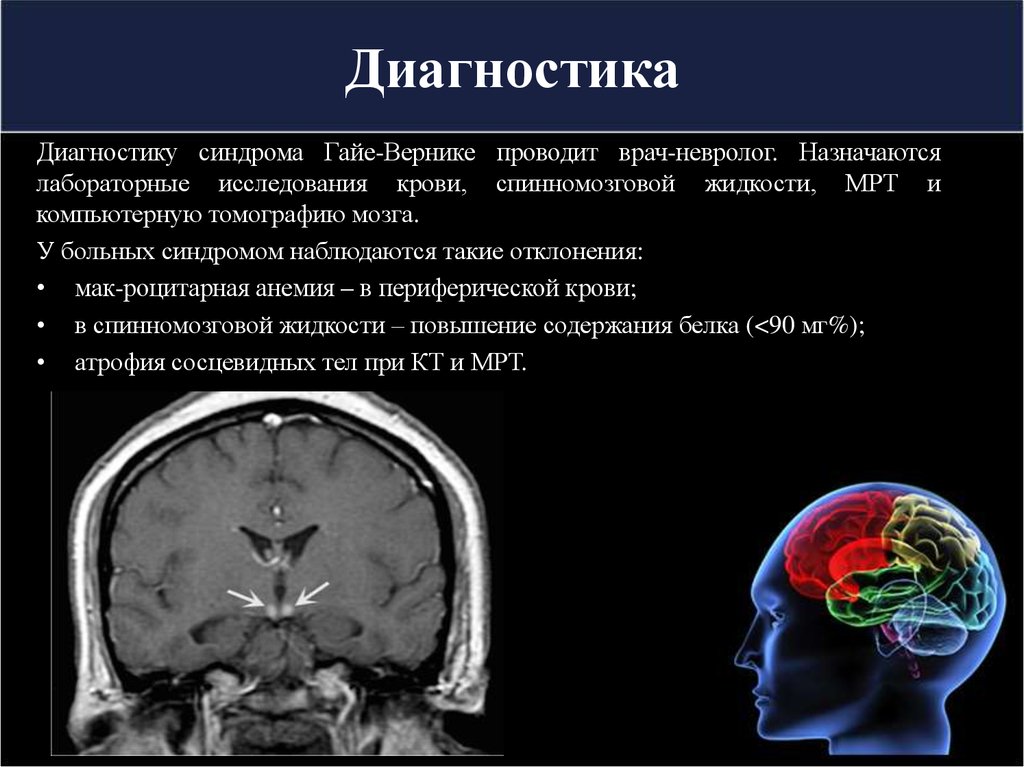 Синдром головного мозга. Энцефалопатия Вернике мрт. Алкогольная энцефалопатия Вернике мрт. Энцефалопатия Вернике кт.