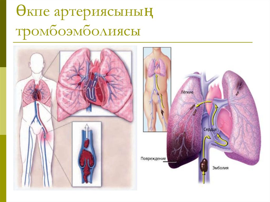 Өкпе артериясының тромбоэмболиясы