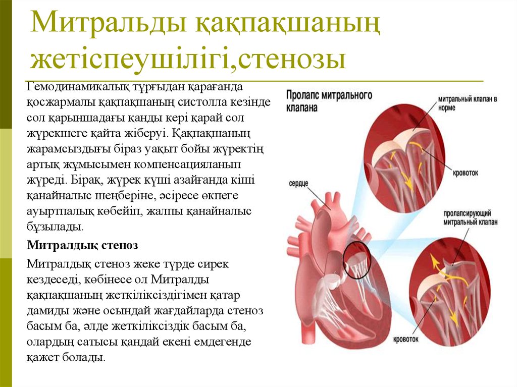 Пролапс мм митрального клапана