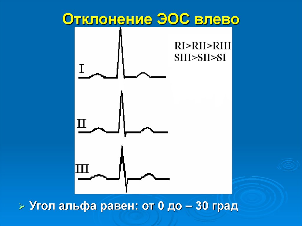 Эос отклонена влево на экг что это