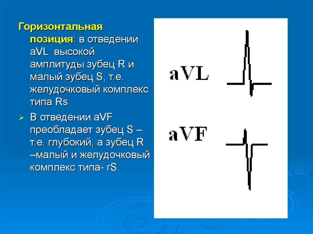 Экг горизонтальная