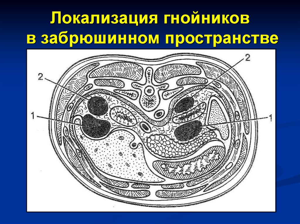 Забрюшинное пространство. Фасции забрюшинного пространства схема. Забрюшинное клетчаточное пространство. Клетчаточные пространства забрюшинного пространства. Околопочечное клетчаточное пространство.