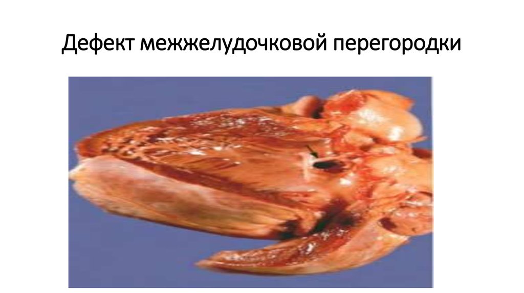 Дефект межжелудочковой перегородки