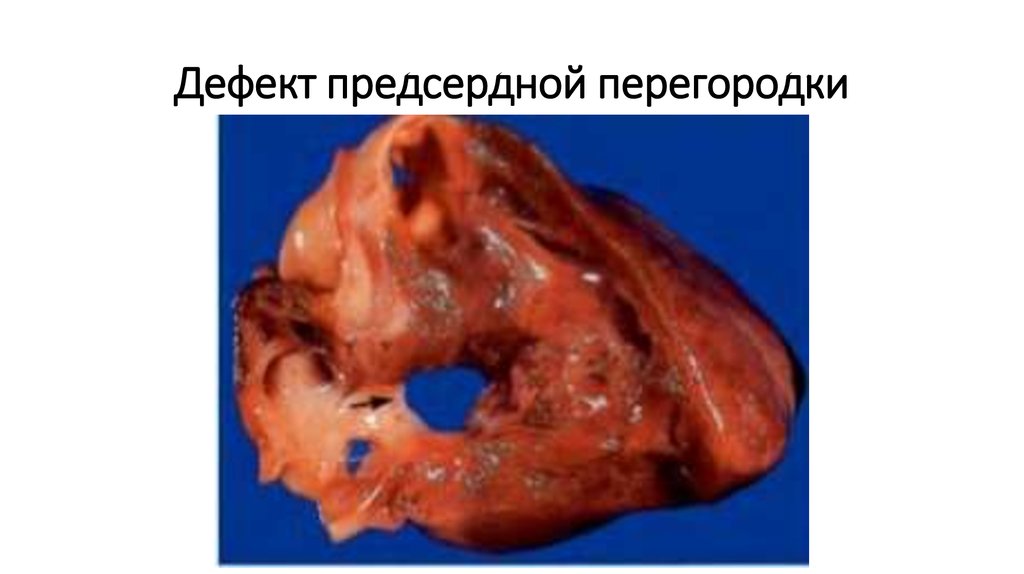 Дефект предсердной перегородки