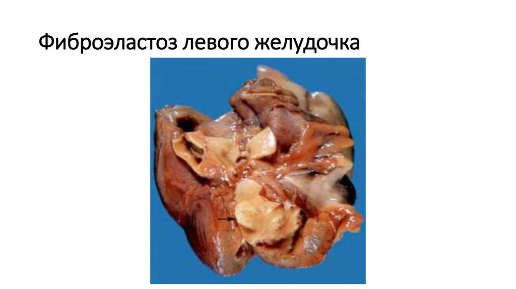 Фиброэластоз левого желудочка