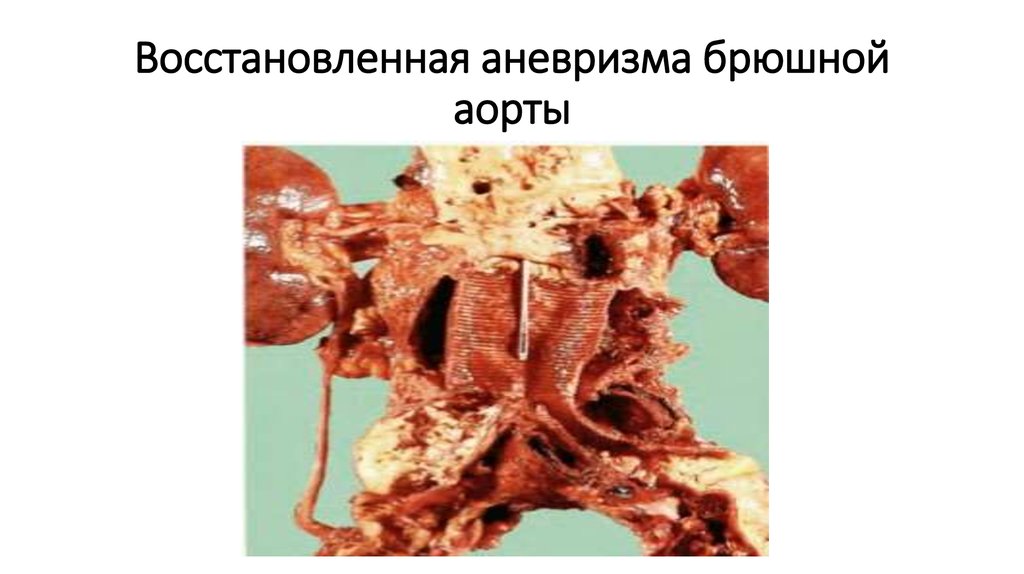 Восстановленная аневризма брюшной аорты